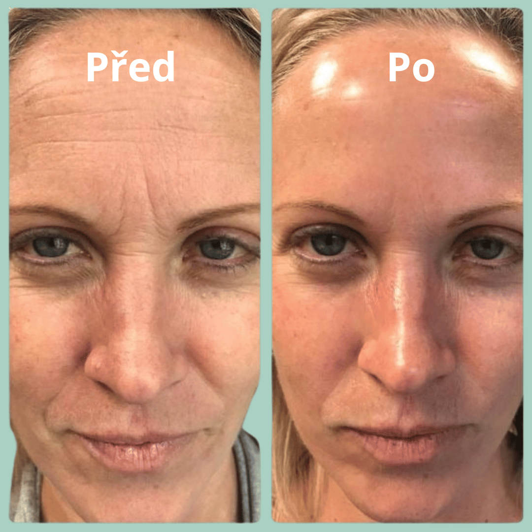 Maska s bio-kolagenem